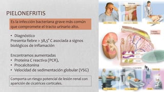 PIELONEFRITIS
Es la infección bacteriana grave más común
que compromete el tracto urinario alto.
• Diagnóstico
Presenta fiebre > 38,5° C asociada a signos
biológicos de inflamación
Encontramos aumentadas
• Proteína C reactiva (PCR),
• Procalcitonina
• Velocidad de sedimentación globular (VSG)
Comporta un riesgo potencial de lesión renal con
aparición de cicatrices corticales.

 