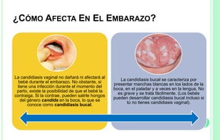 ¿CÓMO AFECTA EN EL EMBARAZO?
La candidiasis vaginal no dañará ni afectará al
bebé durante el embarazo. No obstante, si
tiene una infección durante el momento del
parto, existe la posibilidad de que el bebé la
contraiga. Si la contrae, pueden salirle hongos
del género candida en la boca, lo que se
conoce como candidiasis bucal.
La candidiasis bucal se caracteriza por
presentar manchas blancas en los lados de la
boca, en el paladar y a veces en la lengua. No
es grave y se trata fácilmente. (Los bebés
pueden desarrollar candidiasis bucal incluso si
tú no tienes candidiasis vaginal).
 