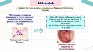 Trichomoniasis
Infección del tracto genital por el protozoario flagelado, Trichomonas
Vaginalis
Secreción vaginal profusa y abundante
grisaceo, amarillo-verdosa, espumosa sin
olor fétido, prurito, escozor, disuria
dispareunia
se exacerba con las relaciones sexuales
Ph: alcalino
Frotis giemsa: Protozoo
flagelado
ETS de origen no viral más
frecuente en el mundo, mujeres >
24 años, incidencia población
general 14.9%, siendo mayor en
mujeres
Tamización para más
infecciones de
transmisión sexual
 