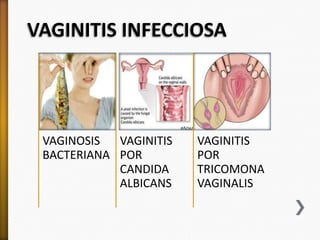 VAGINITIS INFECCIOSA




 VAGINOSIS  VAGINITIS   VAGINITIS
 BACTERIANA POR         POR
            CANDIDA     TRICOMONA
            ALBICANS    VAGINALIS
 