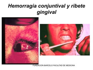 Hemorragia conjuntival y ribete
          gingival




         FUNDACION BARCELO FACULTAD DE MEDICINA
 