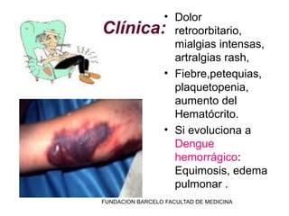 • Dolor
Clínica: retroorbitario,
          mialgias intensas,
          artralgias rash,
        • Fiebre,petequias,
          plaquetopenia,
          aumento del
          Hematócrito.
        • Si evoluciona a
          Dengue
          hemorrágico:
          Equimosis, edema
          pulmonar .
FUNDACION BARCELO FACULTAD DE MEDICINA
 