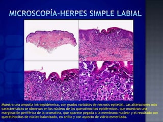 VIRUS HERPES -  Fisiopatologia de la Infeccion, Clinica e Histologia
