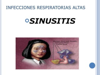 INFECCIONES RESPIRATORIAS ALTAS SINUSITIS 