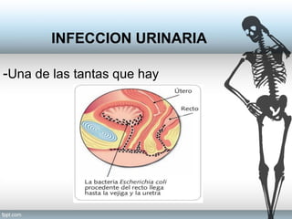 INFECCION URINARIA
-Una de las tantas que hay
 