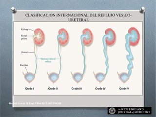 Montini G et al. N Engl J Med 2011;365:239-250
CLASIFICACION INTERNACIONAL DEL REFLUJO VESICO-
URETERAL
 