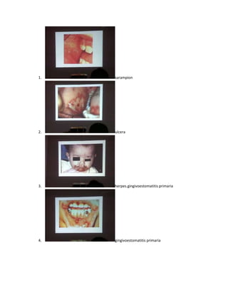 1.   sarampion




2.   ulcera




3.   herpes.gingivoestomatitis primaria




4.   gingivoestomatitis primaria
 