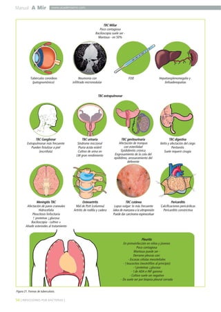 Manual A Mir
54 ] INFECCIONES POR BACTERIAS [
www.academiamir.com
Figura 21. Formas de tuberculosis.
TBC Miliar
Poco contagiosa
Baciloscopia suele ser -
Mantoux - en 50%
Tubérculos coroideos Neumonía con FOD Hepatoesplenomegalia y
(patognomónico) infiltrado micronodular linfoadenopatías
Meningitis TBC
Afectación de pares craneales
Hidrocefalia
Pleocitosis linfocitaria
↑ proteínas ↓glucosa
Baciloscopia - cultivo +
Añadir esteriodes al tratamiento
TBC extrapulmonar
Osteoartritis
Mal de Pott (columna)
Artritis de rodilla y cadera
Pericarditis
Calcificaciones pericárdicas
Pericarditis constrictiva
TBC cutánea
Lupus vulgar: lo más frecuente
Jalea de manzana a la vitropresión
Puede dar carcinoma espinoceluar
TBC Ganglionar
Extrapulmonar más frecuente
Pueden fistulizar a piel
(escrófula)
TBC urinaria
Síndrome miccional
Piuria ácida estéril
Cultivo de orina en
LW gran rendimiento
TBC genitourinaria
Afectación de trompas
con esterilidad
Epididimitis crónica
Engrosamiento de la cola del
epidídimo, arrosaramiento del
deferente
TBC digestiva
Ileítis y afectación del ciego
Peritonitis
Suele requerir cirugía
Pleuritis
En primoinfección en niños y jóvenes
Poco contagiosa
Mantoux puede ser -
Derrame pleuras con:
- Escasas células mesoteliales
- ↑leucocitos (neutrófilos al principio)
- ↑proteínas ↓glucosa
- ↑de ADA e INF gamma
- Cultivo suele ser negativo
- Dx suele ser por biopsia pleural cerrada
 