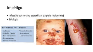Impétigo
• Infecção bacteriana superficial da pele (epiderme)
• Etiologia
 