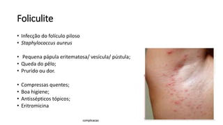 Foliculite
• Infecção do folículo piloso
• Staphylococcus aureus
• Pequena pápula eritematosa/ vesícula/ pústula;
• Queda do pêlo;
• Prurido ou dor.
• Compressas quentes;
• Boa higiene;
• Antissépticos tópicos;
• Eritromicina
complicacao
 
