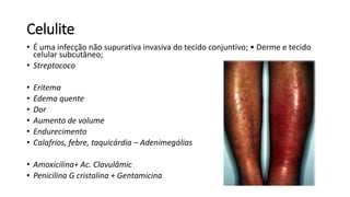 Celulite
• É uma infecção não supurativa invasiva do tecido conjuntivo; • Derme e tecido
celular subcutâneo;
• Streptococo
• Eritema
• Edema quente
• Dor
• Aumento de volume
• Endurecimento
• Calafrios, febre, taquicárdia – Adenimegálias
• Amoxicilina+ Ac. Clavulâmic
• Penicilina G cristalina + Gentamicina
 