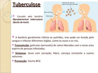 TuberculoseTuberculose
 A bactéria geralmente infecta os pulmões, mas pode ser levada pelo
sangue e infectar diferentes órgãos, como os ossos e os rins.
 Transmissão: gotículas (aerossóis) de saliva liberados com a tosse e/ou
espirro de pessoas infectadas.
 Sintomas: tosse com secreção, febre, cansaço constante e suores
noturnos.
 Prevenção: Vacina BCG
 Causada pela bactéria
Mycobacterium tuberculosis
(Bacilo de Koch)
 