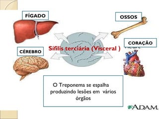 O Treponema se espalha
produzindo lesões em vários
órgãos
Sífilis terciária (Visceral )CÉREBRO
FÍGADO OSSOS
CORAÇÃO
 