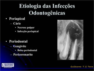Etiologia das Infecções
            Odontogênicas
• Periapical
  – Cárie
     • Necrose pulpar
     • Infecção periapical


• Periodontal
  – Gengivite
     • Bolsa periodontal
  – Pericoronarite
 