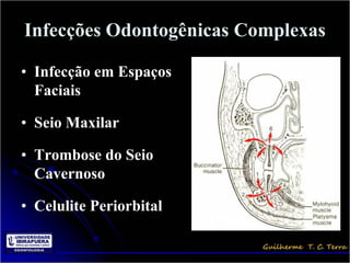 Infecções Odontogênicas Complexas

• Infecção em Espaços
  Faciais

• Seio Maxilar

• Trombose do Seio
  Cavernoso

• Celulite Periorbital
 