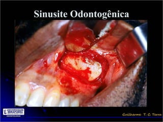 Sinusite Odontogênica
 