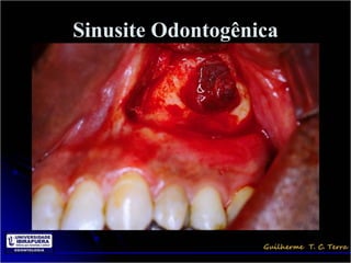 Sinusite Odontogênica
 