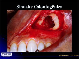 Sinusite Odontogênica
 