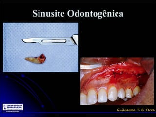 Sinusite Odontogênica
 