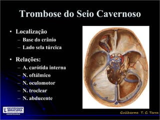 Trombose do Seio Cavernoso
• Localização
  – Base do crânio
  – Lado sela túrcica

• Relações:
  –   A. carótida interna
  –   N. oftálmico
  –   N. oculomotor
  –   N. troclear
  –   N. abducente
 