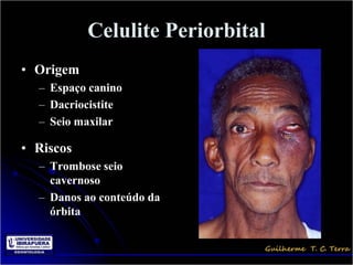 Celulite Periorbital
• Origem
  – Espaço canino
  – Dacriocistite
  – Seio maxilar

• Riscos
  – Trombose seio
    cavernoso
  – Danos ao conteúdo da
    órbita
 