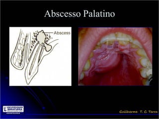 Abscesso Palatino
 