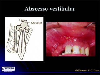 Abscesso vestibular
 