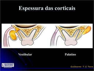 Espessura das corticais




Vestibular        Palatino
 