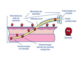 Fluido
contaminado
Colonização na
entrada
Microbiota do
operador
Microbiota da
pele do
paciente
Infecção local
Contaminação
na inserção
Disseminação
através da corrente
sanguínea
Bactéria
 