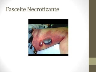 Fasceite Necrotizante
 