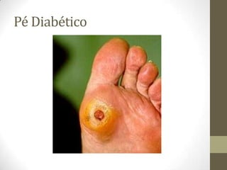 Pé Diabético
 