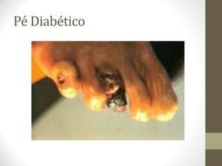 Pé Diabético
 