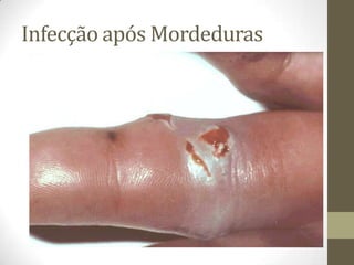 Infecção após Mordeduras
 