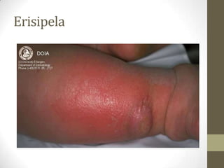 Erisipela
 