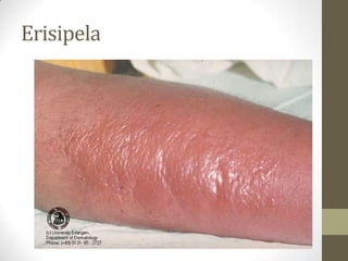 Erisipela
 