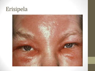 Erisipela
 