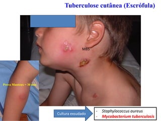 Tuberculose cutânea (Escrófula)
Prova Mantoux = 30 mm
- Staphylococcus aureus
- Mycobacterium tuberculosis
Cultura exsudado
MBS
 