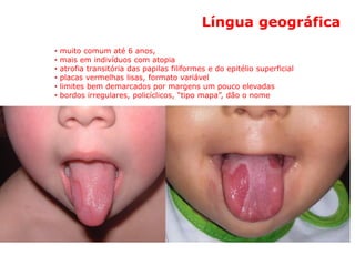 Língua geográfica
• muito comum até 6 anos,
• mais em indivíduos com atopia
• atrofia transitória das papilas filiformes e do epitélio superficial
• placas vermelhas lisas, formato variável
• limites bem demarcados por margens um pouco elevadas
• bordos irregulares, policíclicos, “tipo mapa”, dão o nome
- lesões que se modificam = migram
(glossite migratória)
 