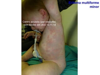 Centro azulado (por vasculite)
com lesões em alvo 13.11.14
Eritema multiforme
minor
 