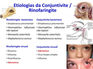 Rinofaringite bacteriana Conjuntivite bacteriana
• Streptococcus pneumoniaie • Streptococcus pneumoniaie
• Haemophilus influenzae
não tipável
• Haemophilus influenzae
não tipável
• Moraxella catarrhalis • Moraxella catarrhalis
• Staphylococcus aureus • Staphylococcus aureus
Rinofaringite virusal Conjuntivite virusal
• Rinovírus • Adenovírus
• Influenza • Vírus herpes simplex
• Parainfluenza • Influenza
• Adenovírus
Etiologias da Conjuntivite /
Rinofaringite
 