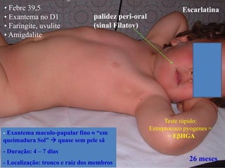 26 meses
Escarlatina
Teste rápido:
Estreptococo pyogenes =
= EHGA
palidez peri-oral
(sinal Filatov)
• Febre 39,5
• Exantema no D1
• Faringite, uvulite
• Amigdalite
- Exantema maculo-papular fino  “em
queimadura Sol”  quase sem pele sã
- Duração: 4 – 7 dias
- Localização: tronco e raiz dos membros
 