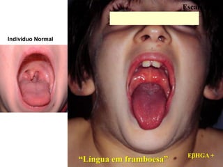 Escarlatina
EHGA +
“Língua em framboesa”
Individuo Normal
 