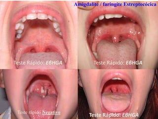 Amigdalite / faringite Estreptocócica
Teste Rápido: EβHGA Teste Rápido: EβHGA
Teste rápido Negativo
Teste Rápido: EβHGA
 