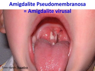 Teste rápido Negativo
Amigdalite Pseudomembranosa
= Amigdalite virusal
 
