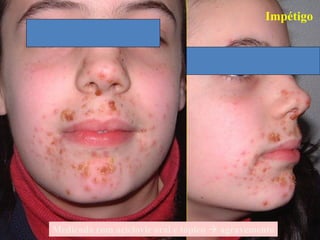 Impétigo
Medicada com aciclovir oral e tópico  agravemento
 