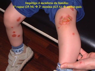 1847 / 885
Impétigo 4 membros da família:
1º rapaz (25 M)  2º menina (4,5 A)  ambos pais
 