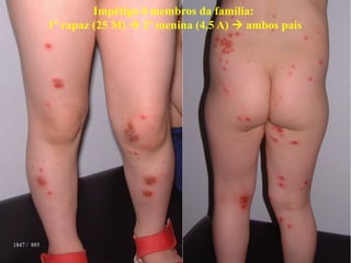1847 / 885
Impétigo 4 membros da família:
1º rapaz (25 M)  2º menina (4,5 A)  ambos pais
 