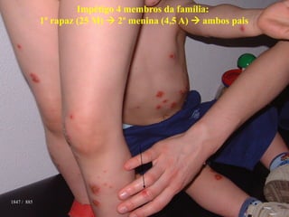 1847 / 885
Impétigo 4 membros da família:
1º rapaz (25 M)  2º menina (4,5 A)  ambos pais
 