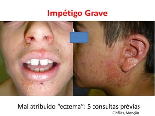 Impétigo Grave
Mal atribuído “eczema”: 5 consultas prévias
Cinfães, Monção
 