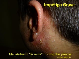 Impétigo Grave
Mal atribuído “eczema”: 5 consultas prévias
Cinfães, Monção
 